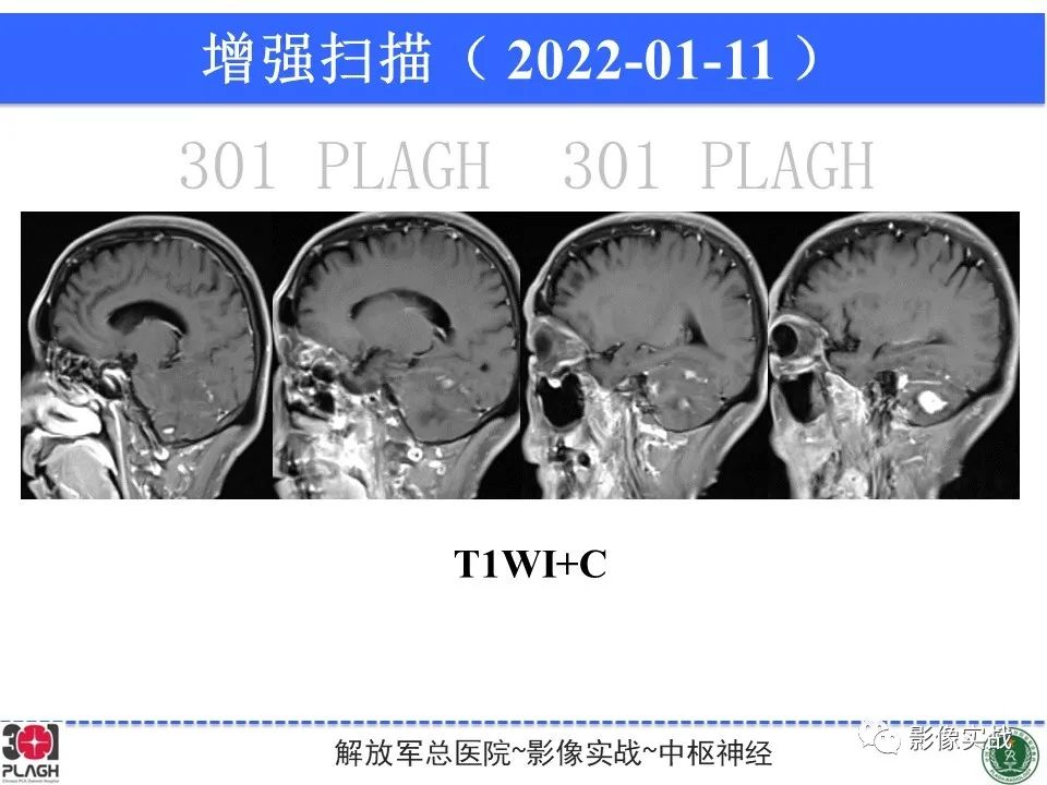 影像PPT - 【PPT】具有毛细胞样特征的高级别星形细胞瘤1例MR-13