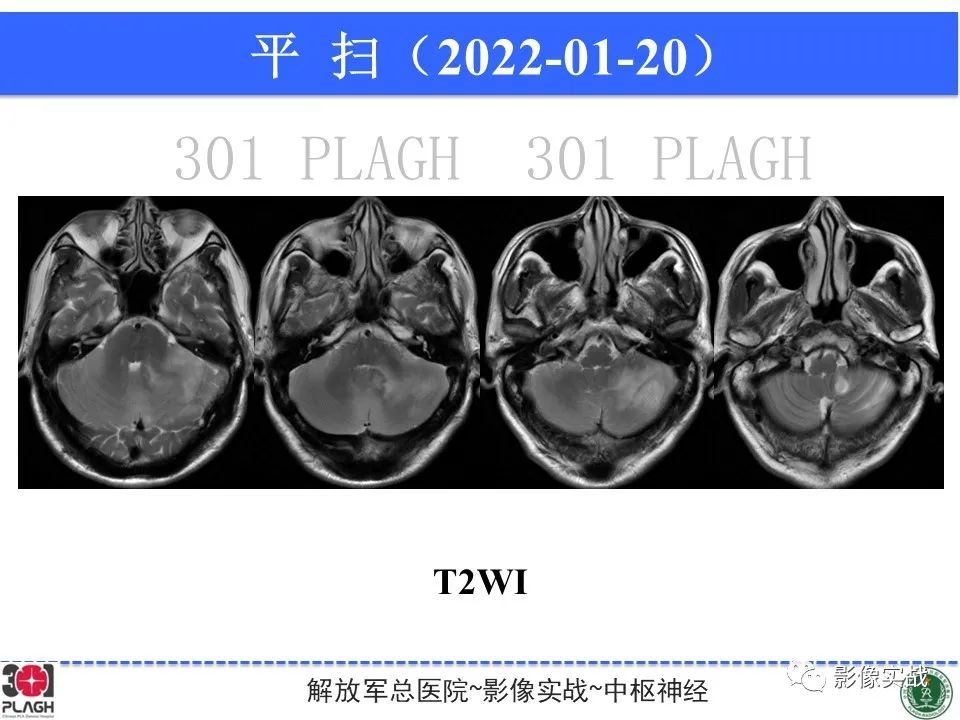 影像PPT - 【PPT】具有毛细胞样特征的高级别星形细胞瘤1例MR-14