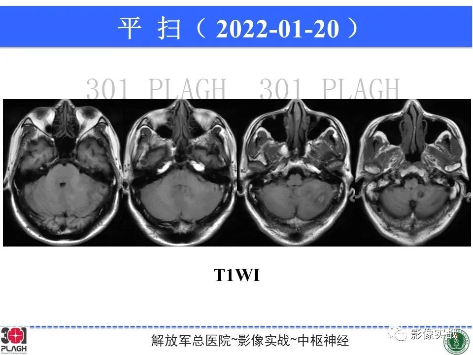 影像PPT - 【PPT】具有毛细胞样特征的高级别星形细胞瘤1例MR-15