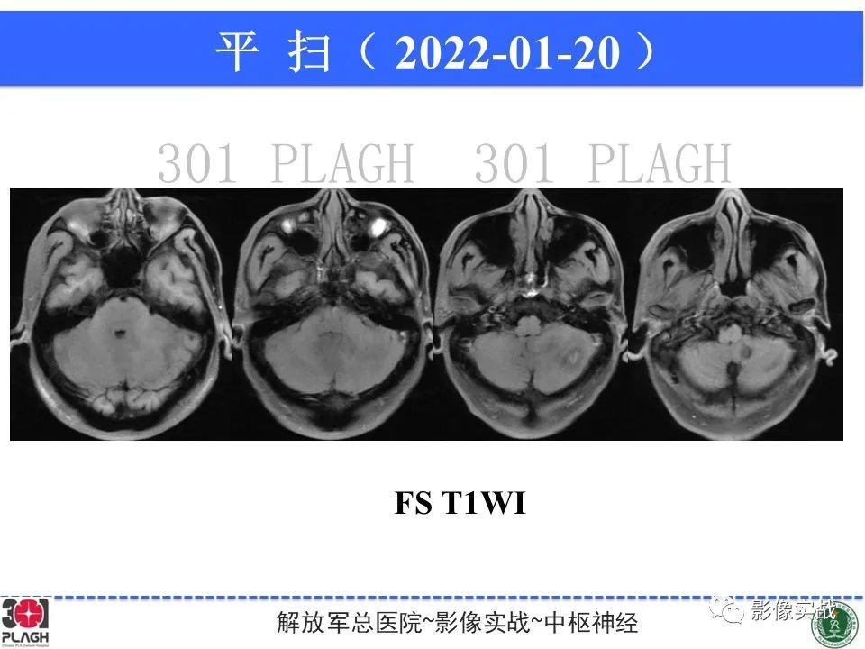 影像PPT - 【PPT】具有毛细胞样特征的高级别星形细胞瘤1例MR-16