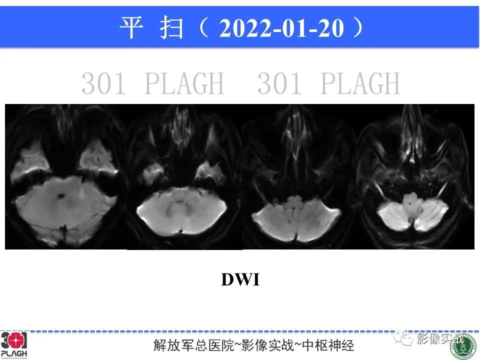 影像PPT - 【PPT】具有毛细胞样特征的高级别星形细胞瘤1例MR-17