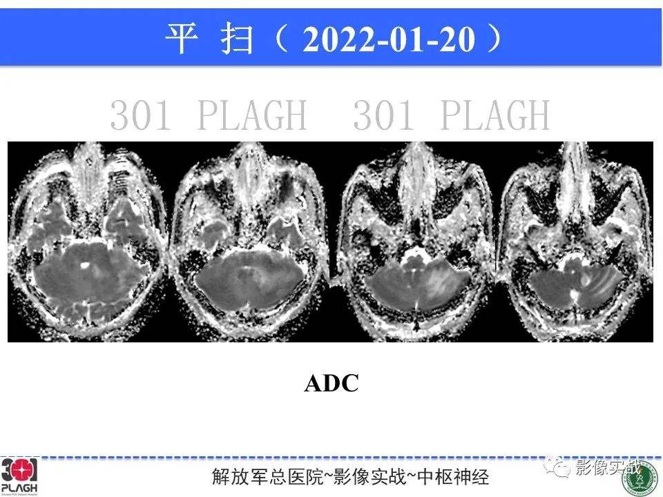 影像PPT - 【PPT】具有毛细胞样特征的高级别星形细胞瘤1例MR-18