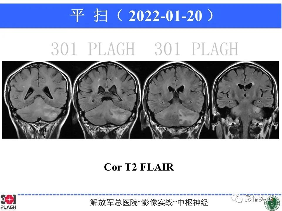 影像PPT - 【PPT】具有毛细胞样特征的高级别星形细胞瘤1例MR-19