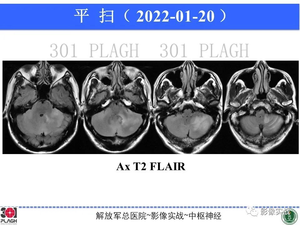 影像PPT - 【PPT】具有毛细胞样特征的高级别星形细胞瘤1例MR-20