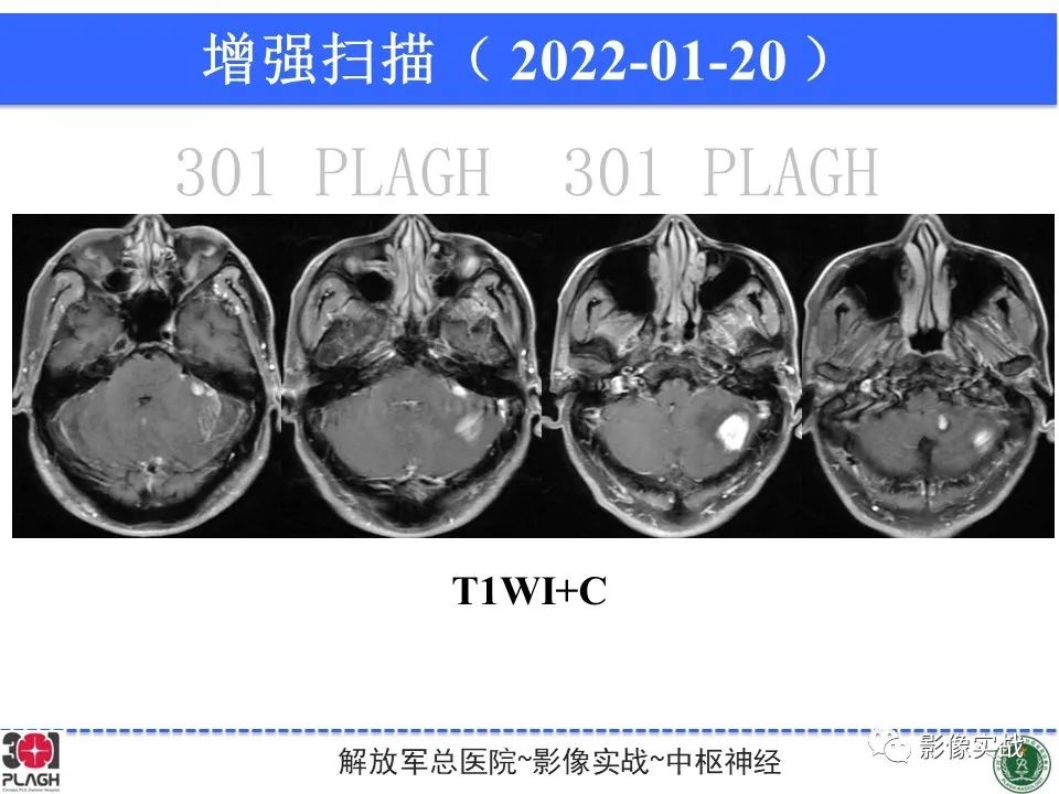 影像PPT - 【PPT】具有毛细胞样特征的高级别星形细胞瘤1例MR-21
