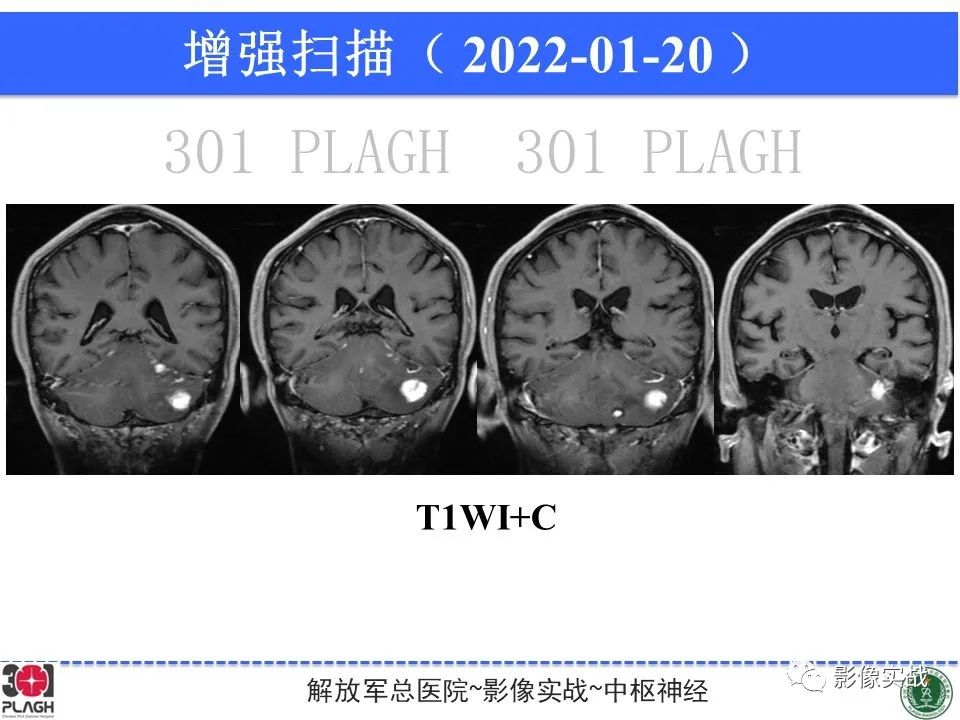 影像PPT - 【PPT】具有毛细胞样特征的高级别星形细胞瘤1例MR-22