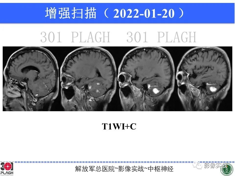 影像PPT - 【PPT】具有毛细胞样特征的高级别星形细胞瘤1例MR-23