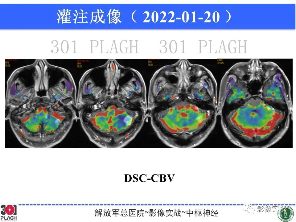 影像PPT - 【PPT】具有毛细胞样特征的高级别星形细胞瘤1例MR-25