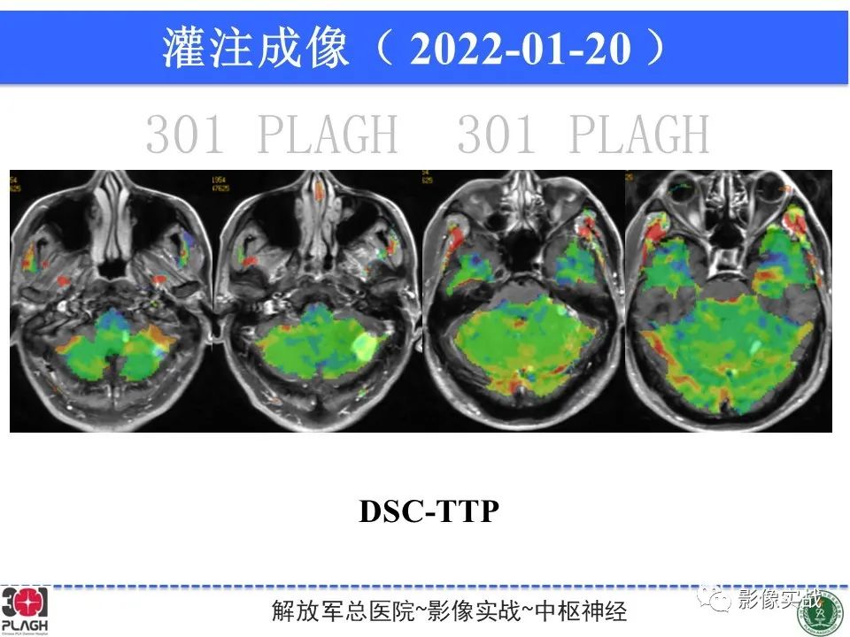 影像PPT - 【PPT】具有毛细胞样特征的高级别星形细胞瘤1例MR-27