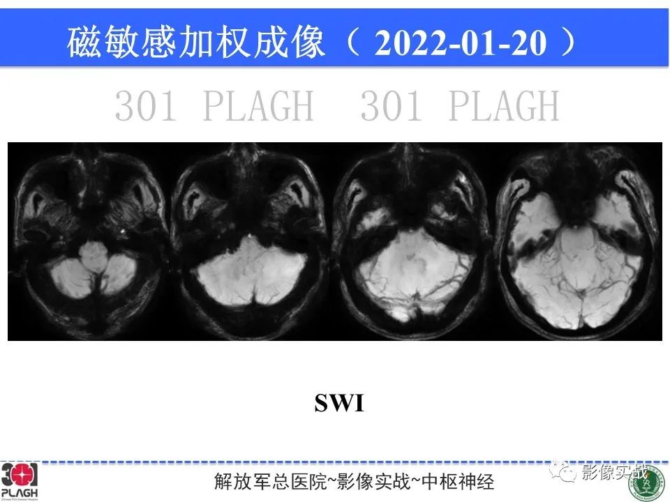 影像PPT - 【PPT】具有毛细胞样特征的高级别星形细胞瘤1例MR-29