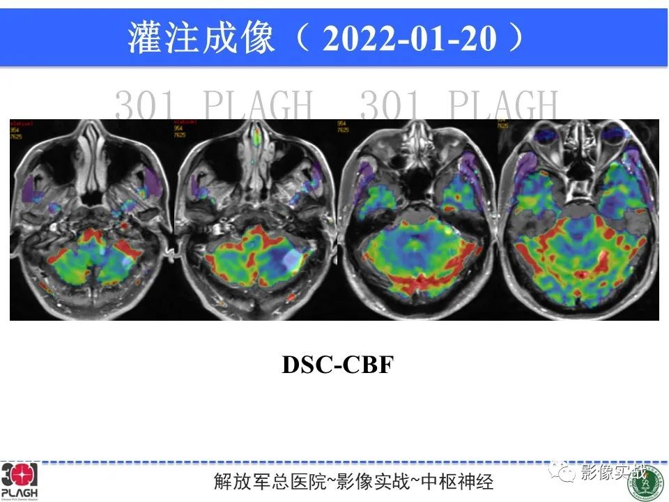 影像PPT - 【PPT】具有毛细胞样特征的高级别星形细胞瘤1例MR-26