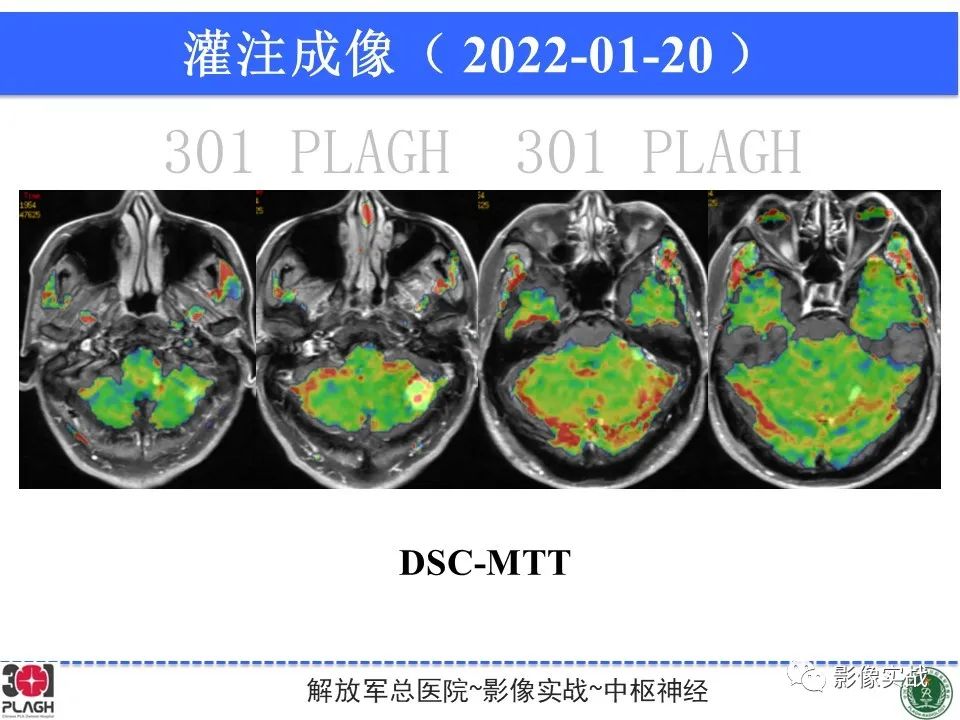 影像PPT - 【PPT】具有毛细胞样特征的高级别星形细胞瘤1例MR-28