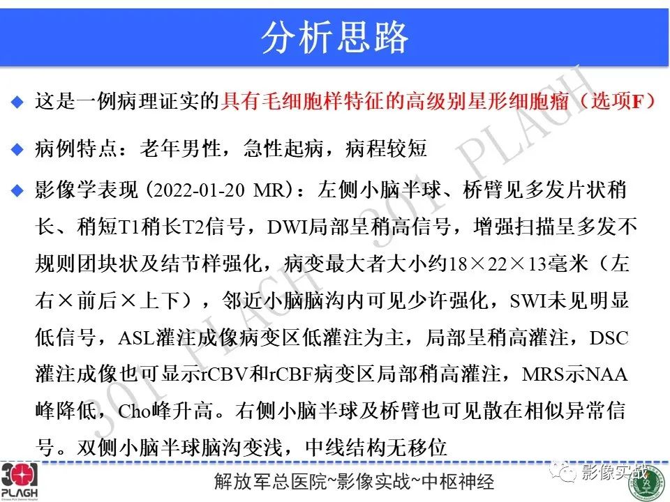 影像PPT - 【PPT】具有毛细胞样特征的高级别星形细胞瘤1例MR-32