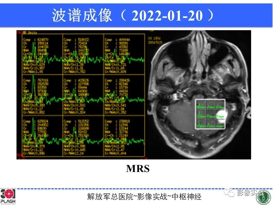 影像PPT - 【PPT】具有毛细胞样特征的高级别星形细胞瘤1例MR-30