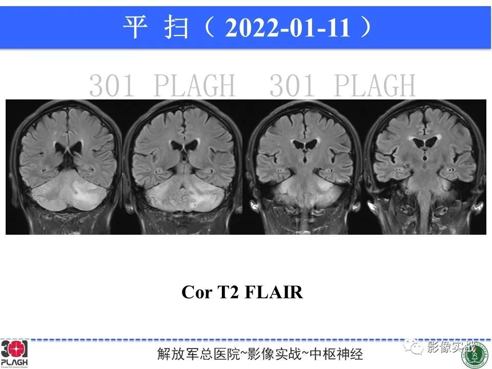 影像PPT - 【PPT】具有毛细胞样特征的高级别星形细胞瘤1例MR-10