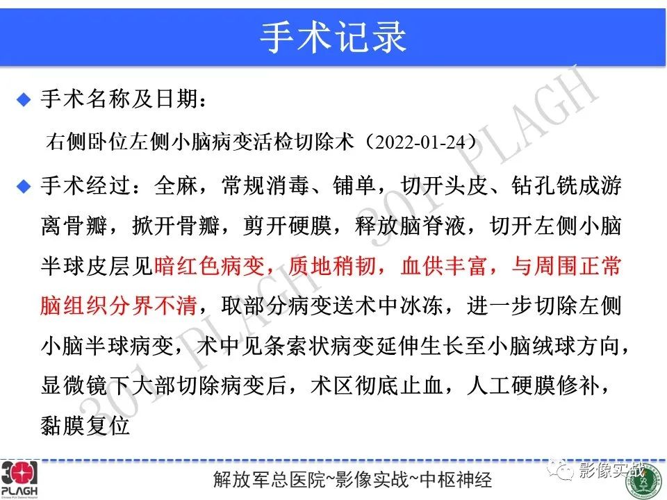 影像PPT - 【PPT】具有毛细胞样特征的高级别星形细胞瘤1例MR-37