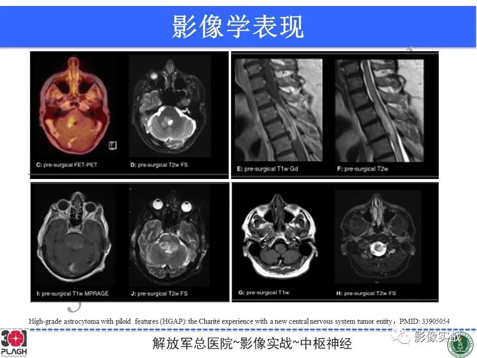 影像PPT - 【PPT】具有毛细胞样特征的高级别星形细胞瘤1例MR-41