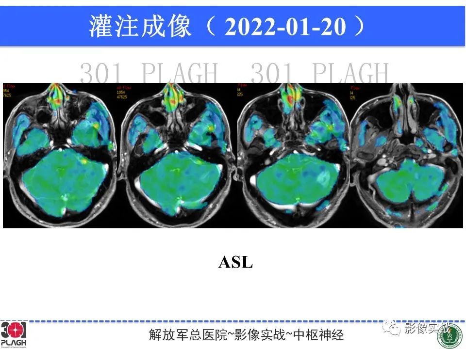 影像PPT - 【PPT】具有毛细胞样特征的高级别星形细胞瘤1例MR-1