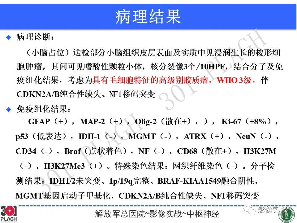 影像PPT - 【PPT】具有毛细胞样特征的高级别星形细胞瘤1例MR-2