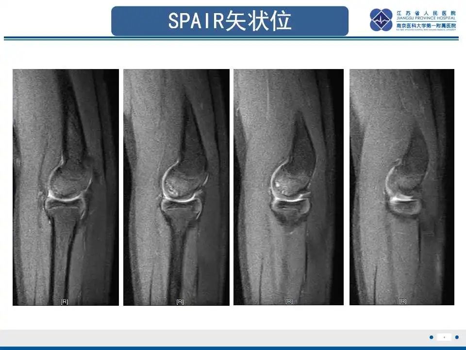影像PPT - 【PPT】肘关节剥脱性骨软骨炎-5