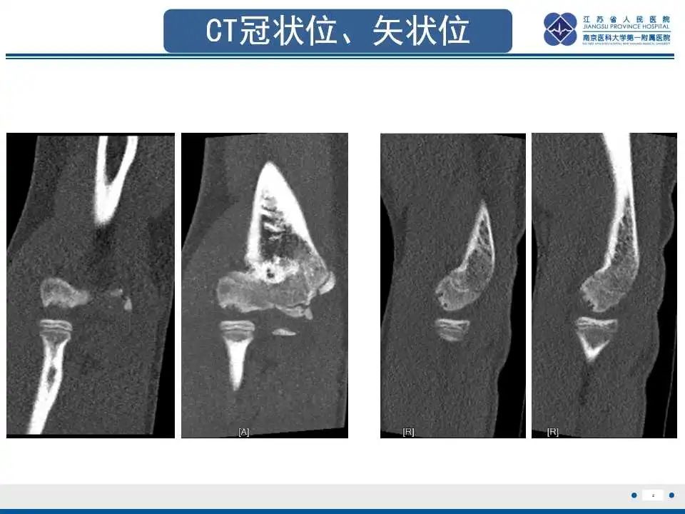 影像PPT - 【PPT】肘关节剥脱性骨软骨炎-3