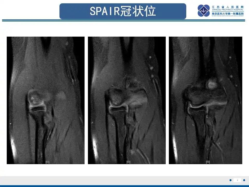 影像PPT - 【PPT】肘关节剥脱性骨软骨炎-4