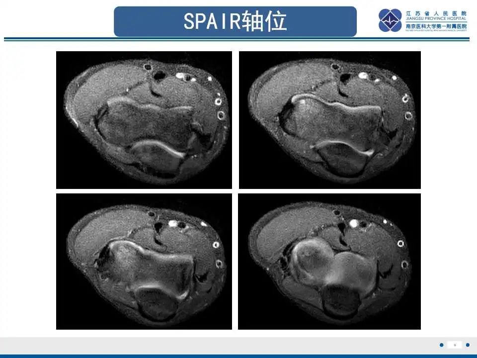 影像PPT - 【PPT】肘关节剥脱性骨软骨炎-6
