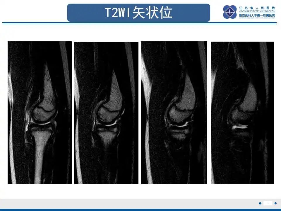 影像PPT - 【PPT】肘关节剥脱性骨软骨炎-8
