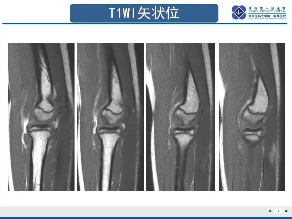 影像PPT - 【PPT】肘关节剥脱性骨软骨炎-7