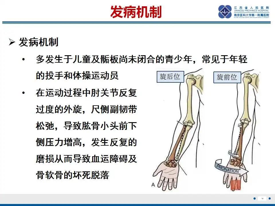影像PPT - 【PPT】肘关节剥脱性骨软骨炎-20