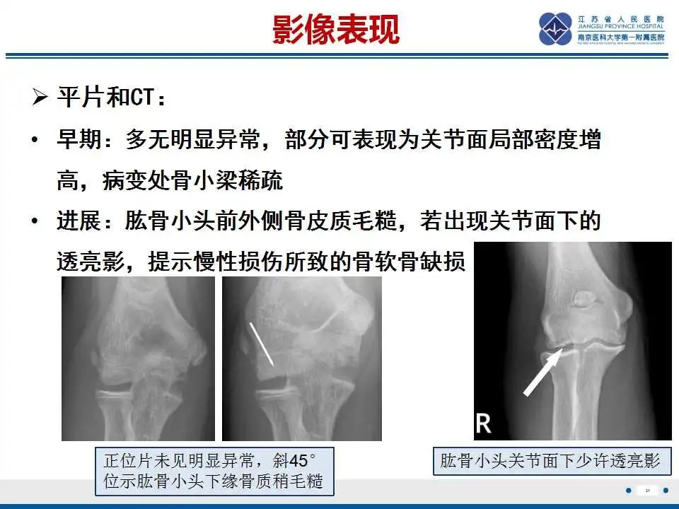 影像PPT - 【PPT】肘关节剥脱性骨软骨炎-22