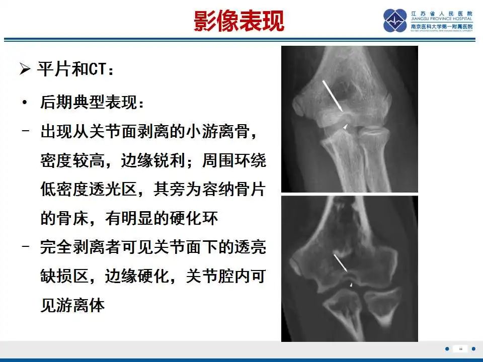 影像PPT - 【PPT】肘关节剥脱性骨软骨炎-23