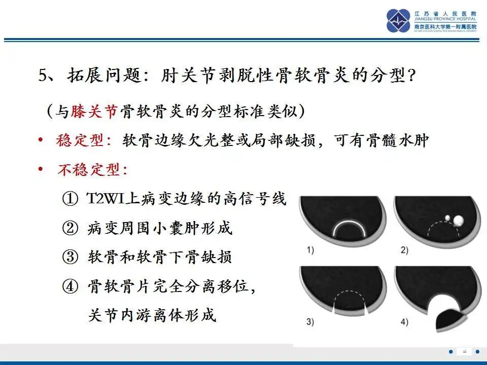 影像PPT - 【PPT】肘关节剥脱性骨软骨炎-26