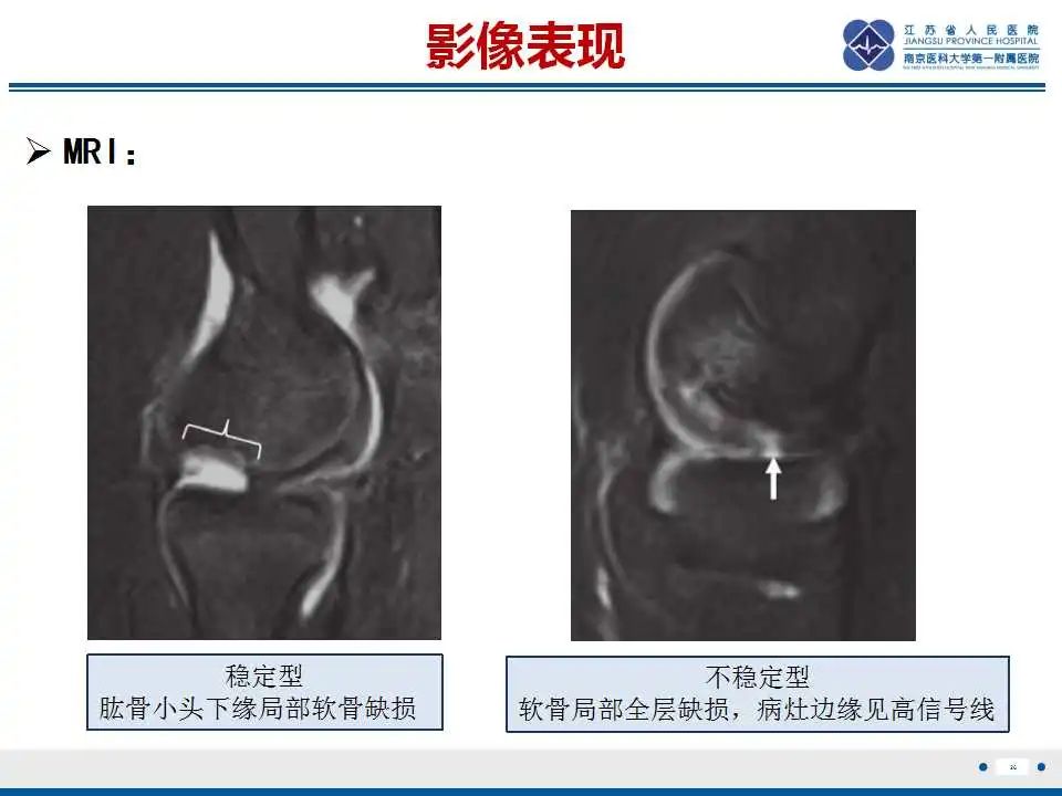 影像PPT - 【PPT】肘关节剥脱性骨软骨炎-27