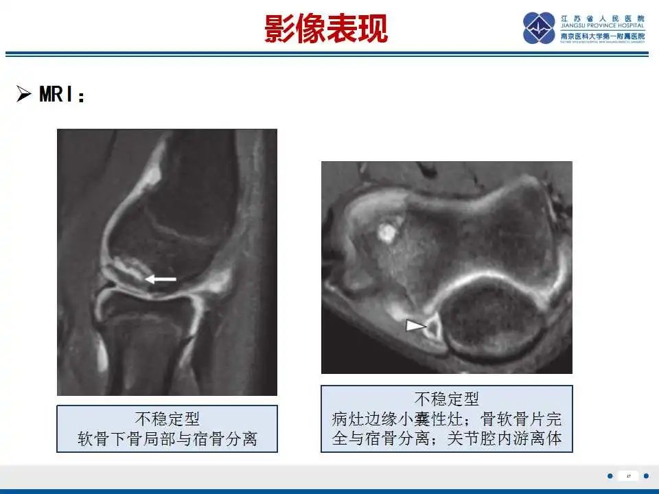 影像PPT - 【PPT】肘关节剥脱性骨软骨炎-28