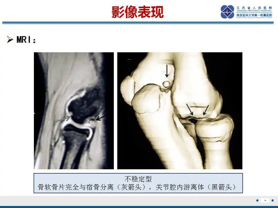 影像PPT - 【PPT】肘关节剥脱性骨软骨炎-29