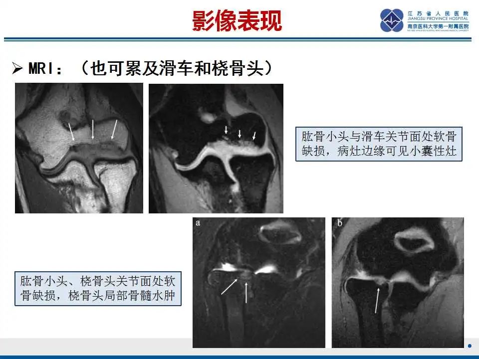 影像PPT - 【PPT】肘关节剥脱性骨软骨炎-30