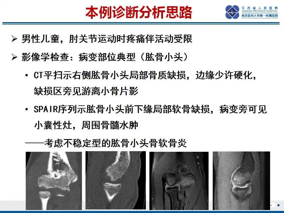 影像PPT - 【PPT】肘关节剥脱性骨软骨炎-31