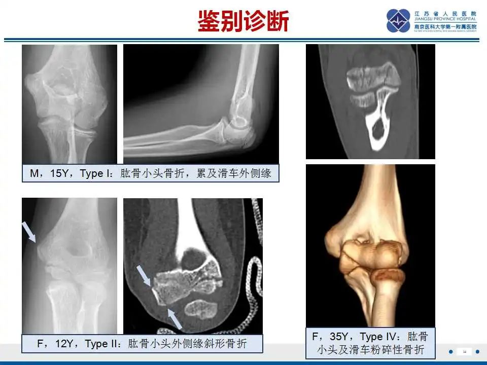 影像PPT - 【PPT】肘关节剥脱性骨软骨炎-33