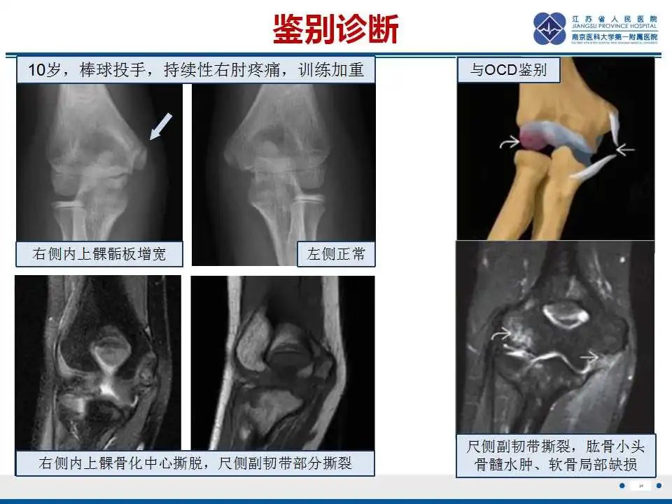 影像PPT - 【PPT】肘关节剥脱性骨软骨炎-35