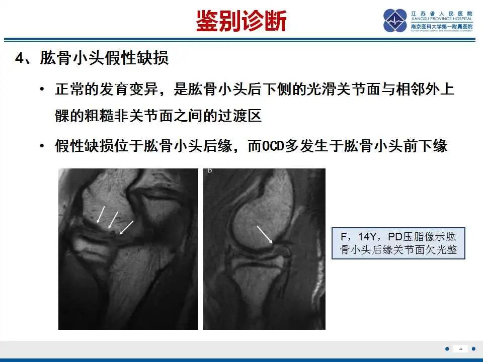 影像PPT - 【PPT】肘关节剥脱性骨软骨炎-37