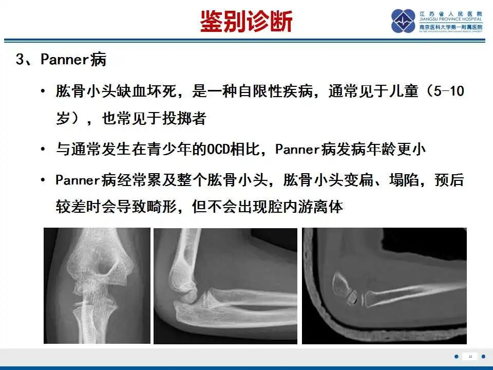 影像PPT - 【PPT】肘关节剥脱性骨软骨炎-36