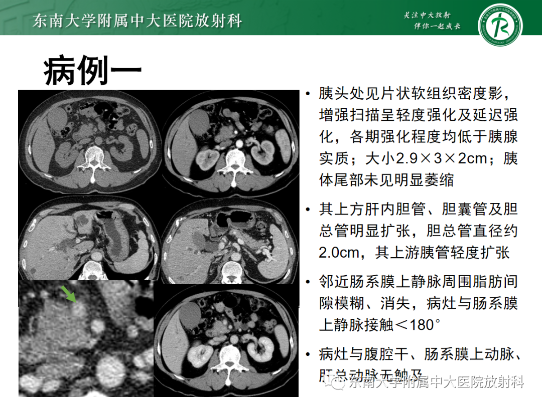 影像PPT - 【PPT】理影外合——胰腺癌-6
