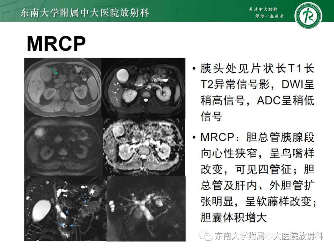 影像PPT - 【PPT】理影外合——胰腺癌-7