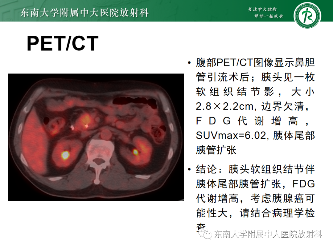 影像PPT - 【PPT】理影外合——胰腺癌-9