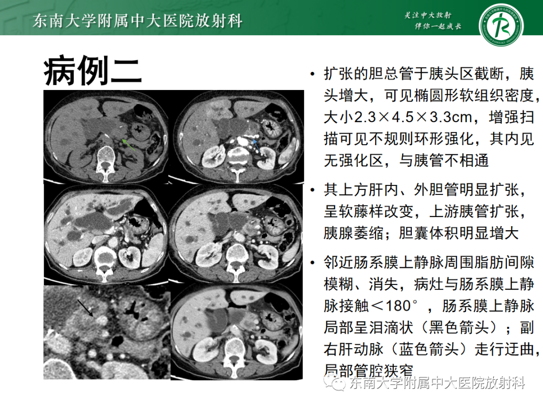 影像PPT - 【PPT】理影外合——胰腺癌-12