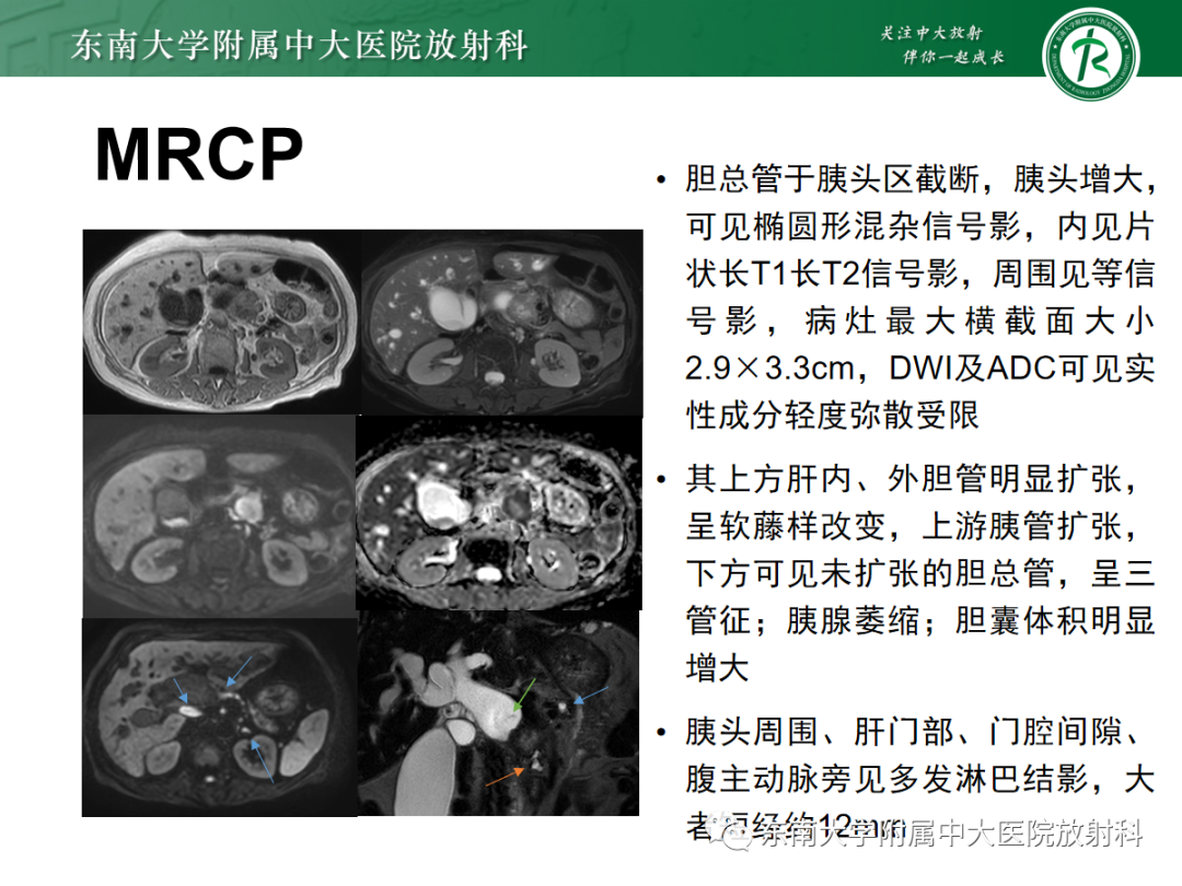 影像PPT - 【PPT】理影外合——胰腺癌-13