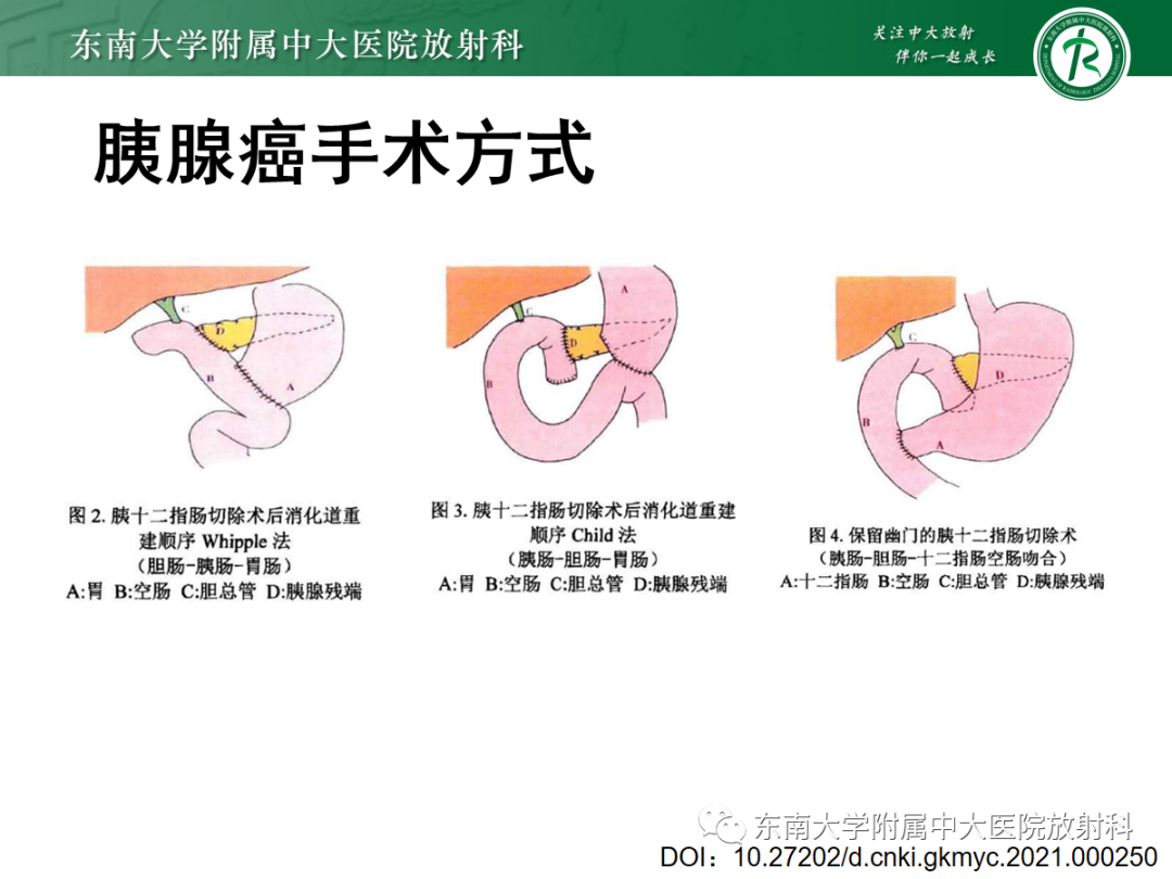 影像PPT - 【PPT】理影外合——胰腺癌-16