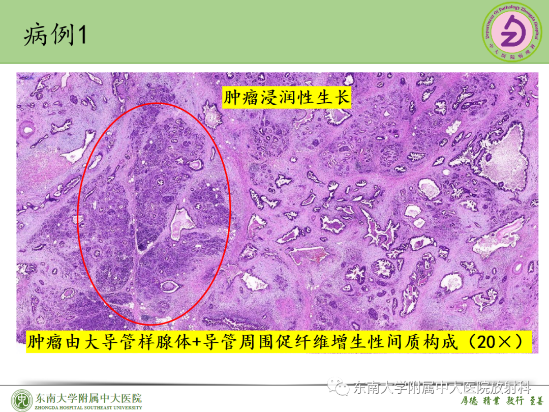 影像PPT - 【PPT】理影外合——胰腺癌-25