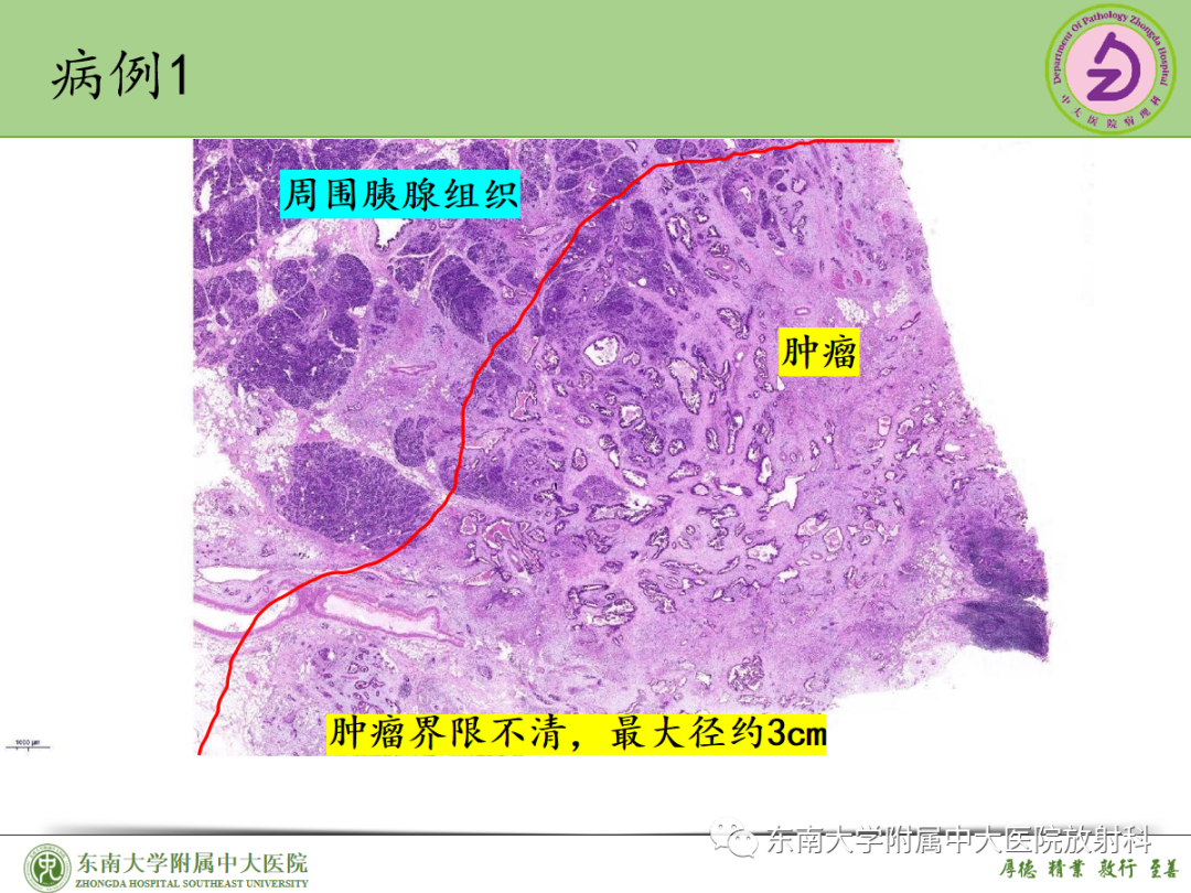 影像PPT - 【PPT】理影外合——胰腺癌-24
